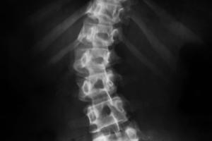 The Symptoms of Scoliosis of the Back