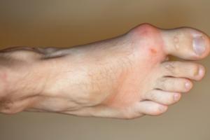 How Does Gout Affect You?