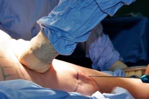 Risks with the Liposuction Procedure