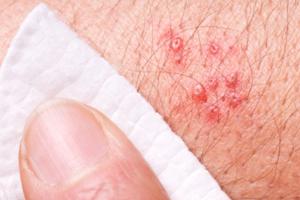 Shingles Treatment and Prevention