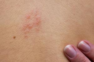What Shingles Vaccinations Are Available to You?