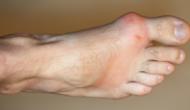 Diagnosis and Treatment of Gout " George is a 46-year-old plumber with pain and swelling in his big toe"