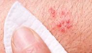 The Importance of Preventing Shingles (Herpes Zoster) " Mike a 63 year old retired exceutive "
