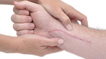 arm massage scar