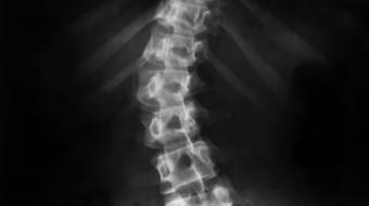Dr. Maziar Badii, MD, FRCP, Rheumatologist, discusses The Symptoms of Scoliosis