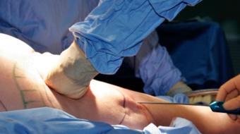 Dr Nancy Van Laeken MD, FRCSC, Plastic Surgeon discusses risks with the liposuction procedure.