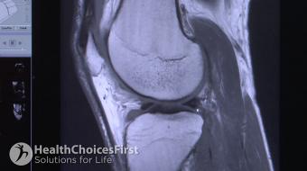Audrey Spielmann, MD FRCP(C), discusses MRI Scans for Knee Injuries and When They Are Important.