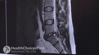 MRI Scans for Lumbar Spine Injuries and Pain Related Conditions