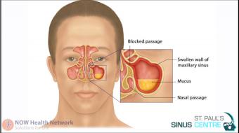 nasal post nasal drip