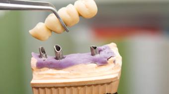 options for implant dental
