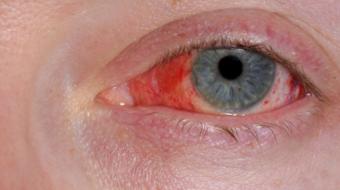 Dr. Duncan Miller, B. Sc, MD, discusses What is Pink Eye.