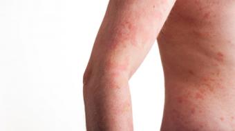 Dr. Jan Peter Dank, MD, Dermatologist, discusses What are Your Treatment Options for Psoriasis.