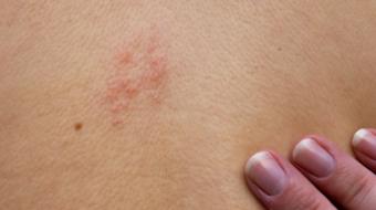 Dr. Daniel Ngui, BSc (P.T), MD, CFPC, FCFP, Family Physician, discusses What Shingles Vaccinations Are Available to You?.