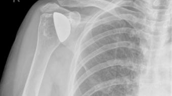 shoulder replacement xray