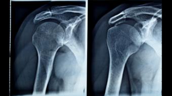 Dr. Patrick Chin, MD, MBA, FRCSC, Orthopedic Surgeon, discusses What is Shoulder Arthritis - Orthopedic Surgery.