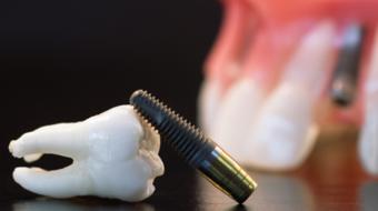 what is implant dental
