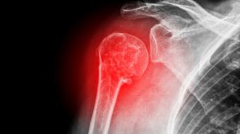 Dr. Patrick Chin, MD, MBA, FRCSC, Orthopedic Surgeon, discusses what is reverse shoulder replacement surgery.