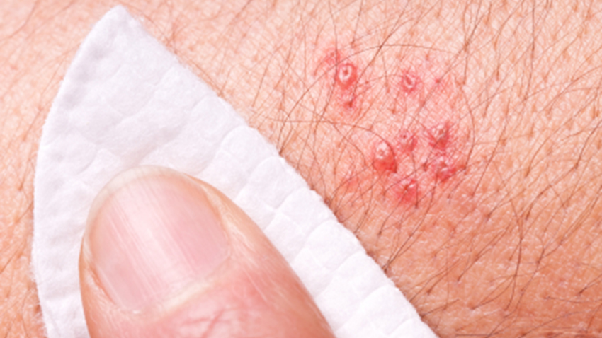 Shingles Treatment And Prevention Health Choices First